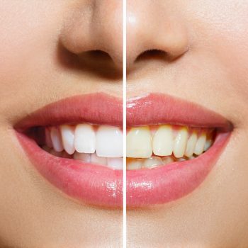 TOOTH WHITENING